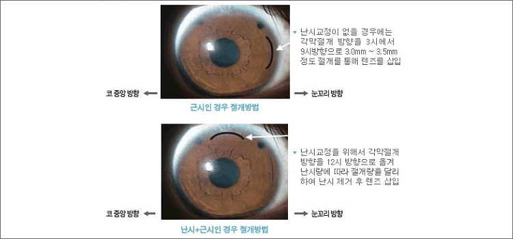 http://www.crystaleye.co.kr/page/info1/?id1=%EC%95%88%EB%82%B4%EB%A0%8C%EC%A6%88%EC%82%BD%EC%9E%85%EC%88%A0&id2=%EB%82%9C%EC%8B%9C%EA%B5%90%EC%A0%95 수정안과에 오신것을 환영합니다