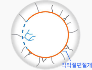 각막신경손상도2.png